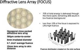 ดูแลหลุมสิว แผลเป็น รอยแตกลาย ด้วย Picosecond Laser เทคนิคเลนส์พิเศษ Micro Lens Array(MLA)