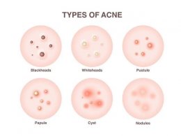 แนะนำเทคนิคดูแลโรคผิวหนัง Ep.4: สิวมี่กี่ชนิด รู้แล้วสำคัญอย่างไร Acne Type?