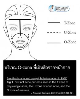แนะนำเทคนิคดูแลปัญหาผิวหนัง Ep.8: สิวจากการใส่หน้ากาก หรือ Maskne วินิจฉัยได้อย่างไร ดูแลรักษาได้อย่างไร?