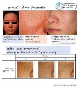 รูขุมขนกว้าง Enlarged Facial Pore เกิดจากอะไรและดูแลได้อย่างไร Part 3/3
