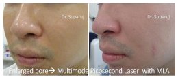 รูขุมขนกว้าง Enlarged Facial Pore เกิดจากอะไรและดูแลได้อย่างไร Part 3/3