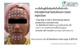 รูขุมขนกว้าง Enlarged Facial Pore เกิดจากอะไรและดูแลได้อย่างไร Part 3/3