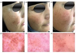 ฝ้าเลือด Telangiectatic Melasma ดูแลได้อย่างไร?