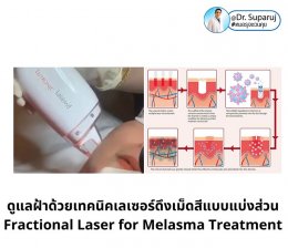 ดูแลฝ้าด้วยเทคนิคเลเซอร์ดึงเม็ดสีแบบแบ่งส่วน Fractional Laser for Melasma Treatment
