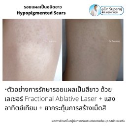 รอยแผลเป็นชนิดขาว Hypopigmented Scars คืออะไร รักษาได้อย่างไร?