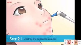 ดูแลรักษาสิวด้วยเทคนิคเข็มคลื่นวิทยุทำลายต่อมไขมัน Micro Insulated Needle RF Acne Resolve
