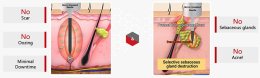 ดูแลรักษาสิวด้วยเทคนิคเข็มคลื่นวิทยุทำลายต่อมไขมัน Micro Insulated Needle RF Acne Resolve