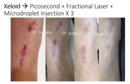 Update เทคนิคการรักษาแผลเป็นคีลอยด์ 2021 Update Scar and Keloid Management