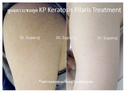 คำแนะนำในการดูแลผิวสำหรับผู้ที่มีปัญหาขนคุด KP Keratosis Pilaris