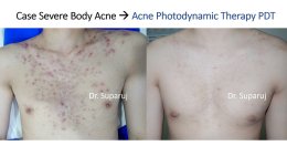 การรักษาสิวด้วย Photodynamic therapy (PDT) คืออะไร?