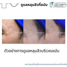 เทคนิคดูแลหลุมสิวบริเวณขมับ !!