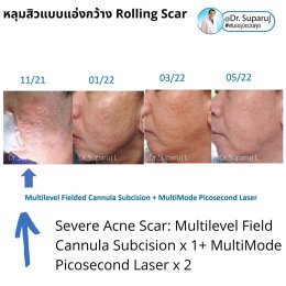 เลเซอร์ Picosecond Laser ช่วยดูแลหลุมสิวดีขึ้นต่อเนื่องถึงเดือนที่ 6 หลังการรักษาครั้งสุดท้าย  