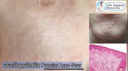 แผลเป็นจากสิวแบบนูน Papular acne scar คืออะไร ? ดูแลได้อย่างไร ?