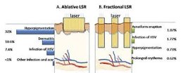 เลเซอร์กรอผิวทั้งชั้น Fully Ablative Laser Resurfacing &เทคนิคเลเซอร์กรอผิวเฉพาะจุด Deep Focus Ablative Laser
