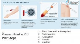 แนะนำเทคนิคดูแลหลุมสิว ep. 12 เกล็ดเลือดเข้มข้น Platelet-rich plasma (PRP)ในการดูแลรักษาหลุมสิว PRP in Acne Scar Treatment (อย่างละเอียดครับ)