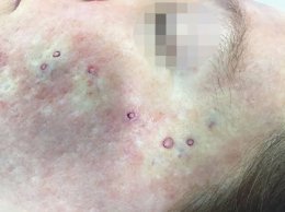 แนะนำเทคนิคดูแลหลุมสิว ep. 16 ดูแลหลุมสิวลึก Ice Pick Scar ด้วยเทคนิคผ่าตัดหลุมสิว Acne Scar Revision: Punch Excision + เลเซอร์ MultiMode Picosecond Laser