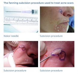 ดูแลหลุมสิวด้วยการตัดเซาะพังผืด Acne Scar Subcision คืออะไร มีเทคนิคอย่างไร ?