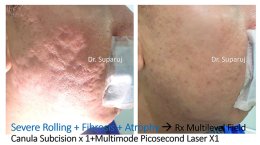 ดูแลหลุมสิวด้วยการตัดเซาะพังผืด Acne Scar Subcision คืออะไร มีเทคนิคอย่างไร ?