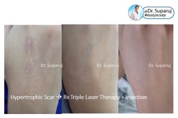 ดูแลรอยแผลผ่าตัด Surgical Scar เพื่อป้องกันการเกิดแผลเป็นนูนเกิน Hyperthrophic Scar และคีลอยด์ Keloid