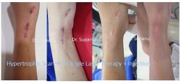 ดูแลรอยแผลผ่าตัด Surgical Scar เพื่อป้องกันการเกิดแผลเป็นนูนเกิน Hyperthrophic Scar และคีลอยด์ Keloid