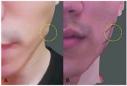 ฉีด Botulinum Toxin ที่กล้ามเนื้อกราม Masseter muscleแล้วมีก้อนเวลากัดฟันเกิดจากอะไร แก้ไขได้อย่างไร?