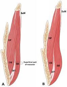 ฉีด Botulinum Toxin ที่กล้ามเนื้อกราม Masseter muscleแล้วมีก้อนเวลากัดฟันเกิดจากอะไร แก้ไขได้อย่างไร?