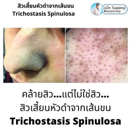 คล้ายสิว…แต่ไม่ใช่สิว… แต่เป็น…สิวเสี้ยนหัวดำจากเส้นขน Trichostasis Spinulosa?