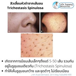 คล้ายสิว…แต่ไม่ใช่สิว… แต่เป็น…สิวเสี้ยนหัวดำจากเส้นขน Trichostasis Spinulosa?