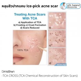 เทคนิครักษาหลุมสิวด้วยการแต้มกรด TCA บริเวณแผลเป็นหลุมสิว TCA CROSS (TCA Chemical Reconstruction of Skin Scars)