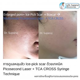 เทคนิครักษาหลุมสิวด้วยการแต้มกรด TCA บริเวณแผลเป็นหลุมสิว TCA CROSS (TCA Chemical Reconstruction of Skin Scars)