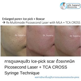 เทคนิครักษาหลุมสิวด้วยการแต้มกรด TCA บริเวณแผลเป็นหลุมสิว TCA CROSS (TCA Chemical Reconstruction of Skin Scars)