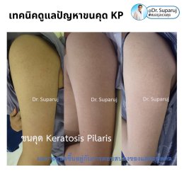 เทคนิคดูแลปัญหาขนคุด KP Keratosis Pilaris Treatment ขนคุด (Keratosis Pilaris) หรือเรียนอีกชื่อว่า “ผิวหนังไก่”