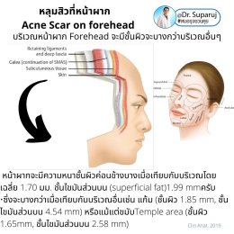 หลุมสิวที่หน้าผาก Acne Scar on forehead มีเทคนิคดูแลต่างจากบริเวณอื่นอย่างไร?