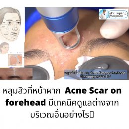หลุมสิวที่หน้าผาก Acne Scar on forehead มีเทคนิคดูแลต่างจากบริเวณอื่นอย่างไร?