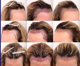 การปลูกผม (Hair Transplantation) คืออะไร