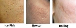 ดูแลหลุมสิวลึกด้วยการแต้ม TCA CROSS โดยการใช้เทคนิค Painting (TCA Chemical Reconstruction of Skin Scars)