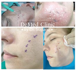 รักษาหลุมสิวด้วยการผ่าตัด Acne Scar Revision ด้วยเทคนิคผ่าตัดออก Punch Excision