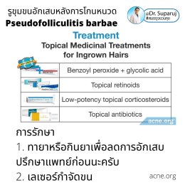 เทคนิคการโกนหนวดและดูแลผิวเพื่อลดการเกิด รูขุมขนอักเสบหลังการโกนหนวด Pseudofolliculitis barbae, Razor bump