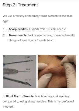 Update เทคนิค Subcision ตัดพังผืดรักษาหลุมสิว Acne Scar Subcision Techniques