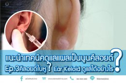 แนะนำเทคนิคดูแลแผลเป็นนูนคีลอยด์ Ep. 3 คีลอยด์ใบหู? Ear Keloid ดูแลได้อย่างไร?