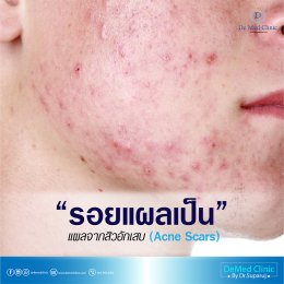 รักษารอยแผลเป็นด้วยนวัตกรรม Picosecond Laser หมดปัญหาผิวไม่เรียบ ไม่สวยจากรอยแผลเป็น หลุมสิว หรือรอยแผลทุกชนิด
