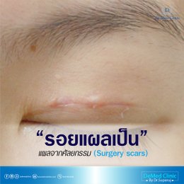รักษารอยแผลเป็นด้วยนวัตกรรม Picosecond Laser หมดปัญหาผิวไม่เรียบ ไม่สวยจากรอยแผลเป็น หลุมสิว หรือรอยแผลทุกชนิด