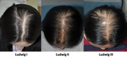 ผมบางศีรษะล้านจากพันธุกรรมในเพศหญิง  Androgenetic Alopecia AGA, Female pattern hair loss