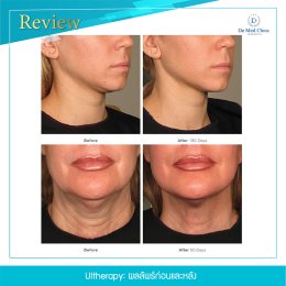 Ultherapy เทคโนโลยีการรักษาที่ได้รับการรับรองจากองค์การอาหารและยาว่า สามารถสามารถ ยกกระชับใต้คาง ลดเหนียง และกระตุ้นการสร้างคอลลาเจนใหม่ซึ่งทำให้ผิวกระชับและยกกระชับขึ้น