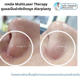 แนะนำเทคนิคดูแลแผลเป็นจากการผ่าตัด: ดูแลแผลเป็นนูนจากการผ่าตัดปีกจมูก Alarplasty ด้วยเทคนิค MultiLaser Therapy: Picosecond Laser + Gold Toning + Fractional Laser + Injection