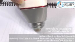 Update เปรียบเทียบ 3 เทคนิครักษาหลุมสิว Discovery Pico Laser VS InfiniRF Microneedle VS Fractional CO2 Laser แตกต่างกันอย่างไร เทคนิคไหนได้ผลดีที่สุด ?