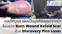 แนะนำเทคนิคดูแลแผลเป็น: เทคนิคดูแล แผลเป็นนูนคีย์ลอยด์จากน้ำร้อนลวก Burn Wound Keloid Scar ด้วย Discovery Pico Laser
