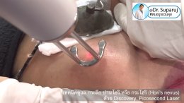 เทคนิครักษากระโฮริ กระลึก ปานโฮริ (Hori's nevus) ด้วยเลเซอร์ Discovery Picosecond Laser