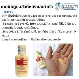 สิวที่หลัง และลำตัว Truncal & Body Acne เกิดจากอะไรและดูแลรักษาได้อย่างไร ? (Update + รีวิว)