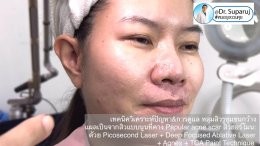 เทคนิควิเคราะห์ปัญหา & รักษาหลุมสิว รูขุมขนกว้าง แผลเป็นจากสิวแบบนูน Papular acne scar สิวฮอร์โมน: ด้วย Picosecond Laser + Deep Focused Ablative Laser + Agnes + TCA Paint Technique